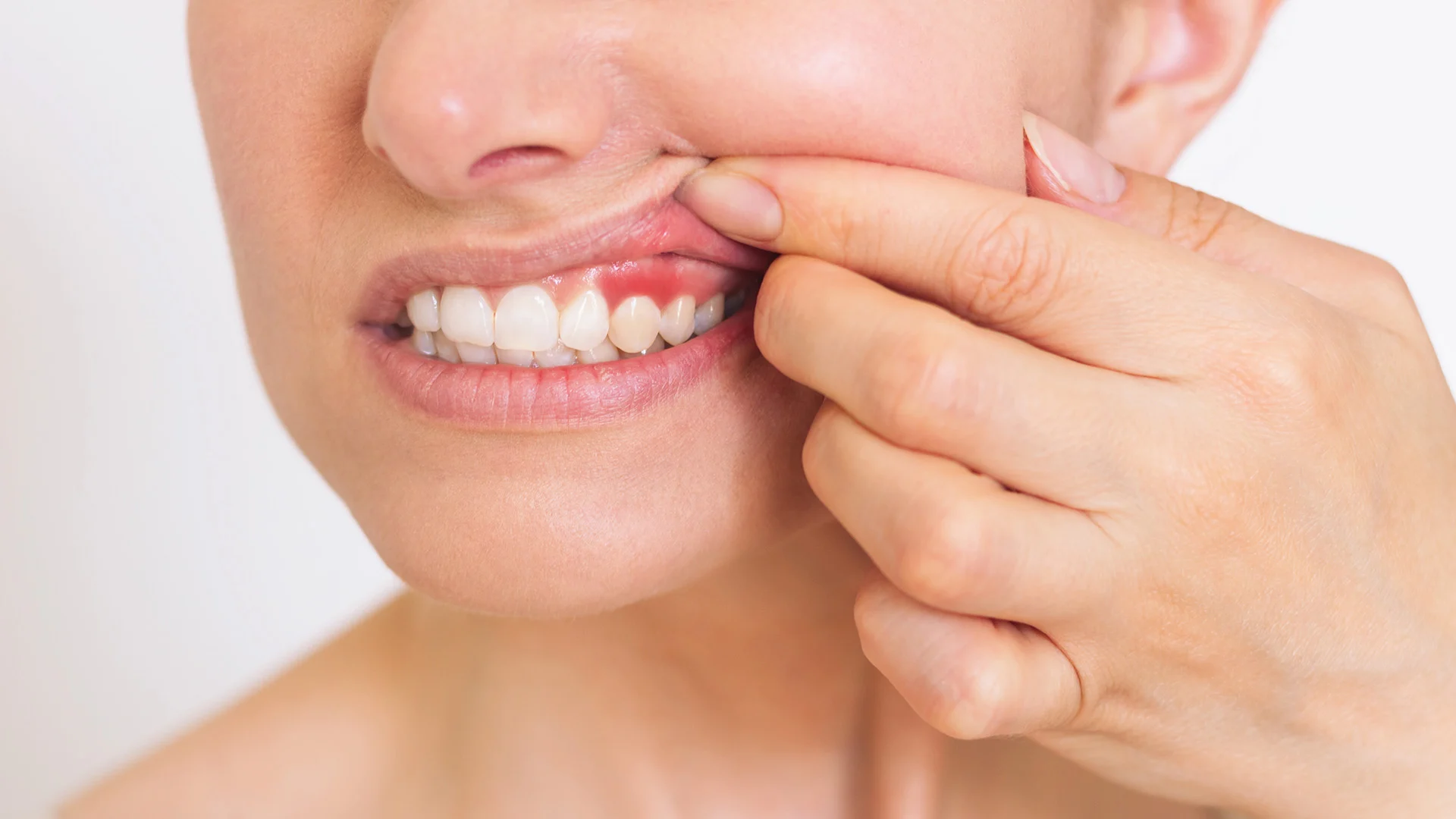 Understanding Gingivitis and Periodontitis