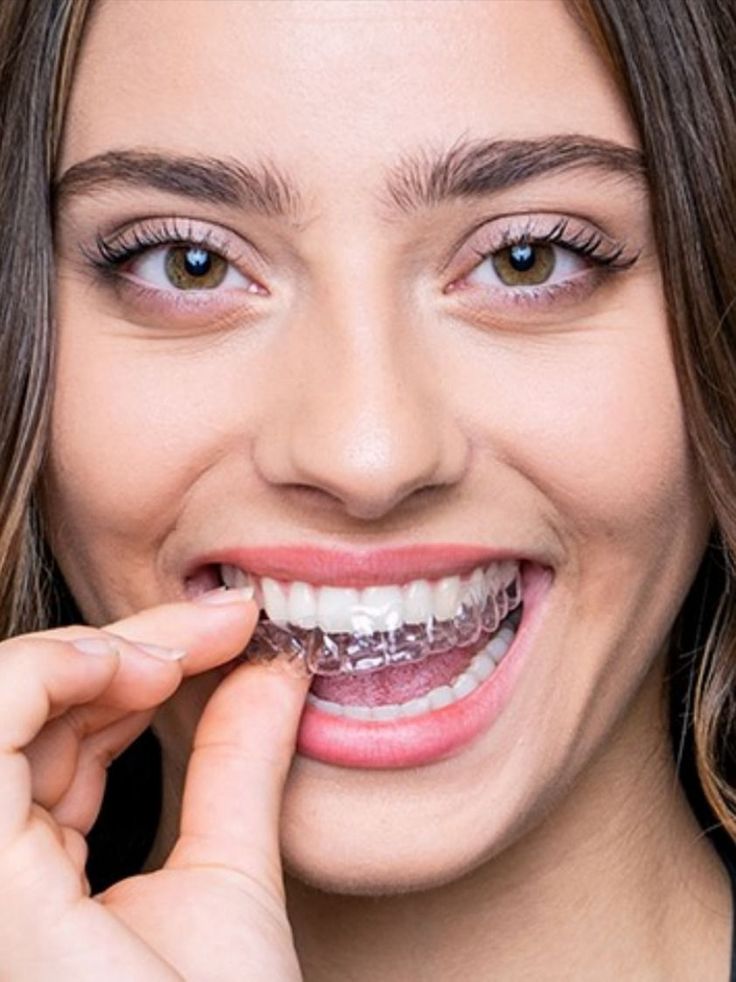 Teeth Straightening in Dubai